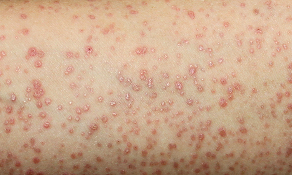 Acupuncture and Holistic Dermatology for Lichen Planus | Portland, OR