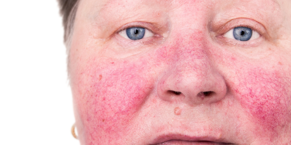 Acupuncture and Holistic TCM Dermatology for Rosacea | Portland, OR
